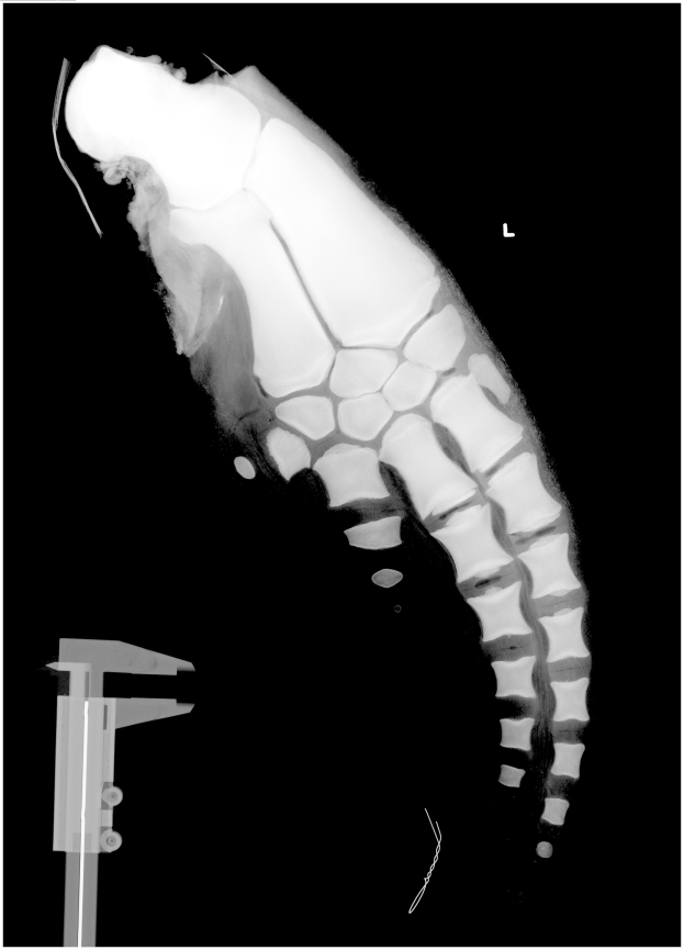 Ein Röntgenbild eines Männerbeins mit einer Fraktur in der Mitte, mit einem Metallband auf der linken Seite, vor schwarzem Hintergrund.